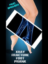 Xray Fracture Foot Prank Image